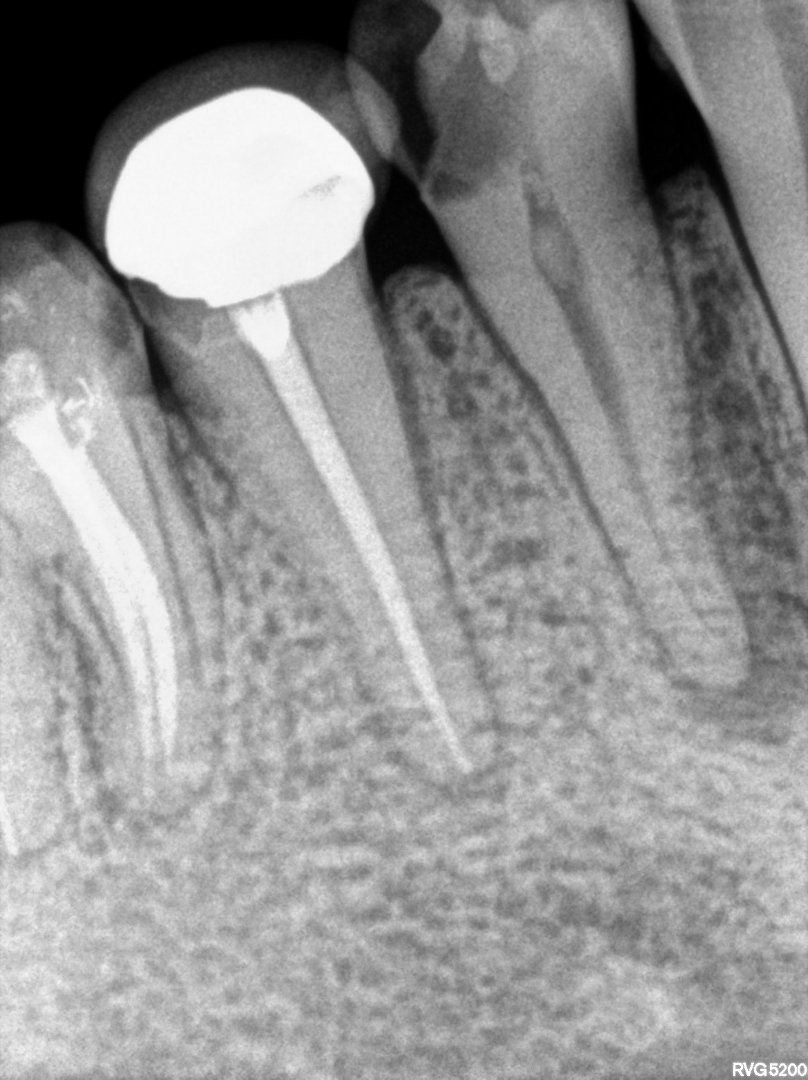 Dental X-ray